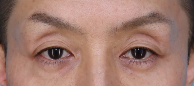 症例写真,こめかみ・頬のこけ・フェイスライン・目元のくぼみにヒアルロン酸注入を行った男性の症例写真,Before,ba_kubomi015_b02.jpg