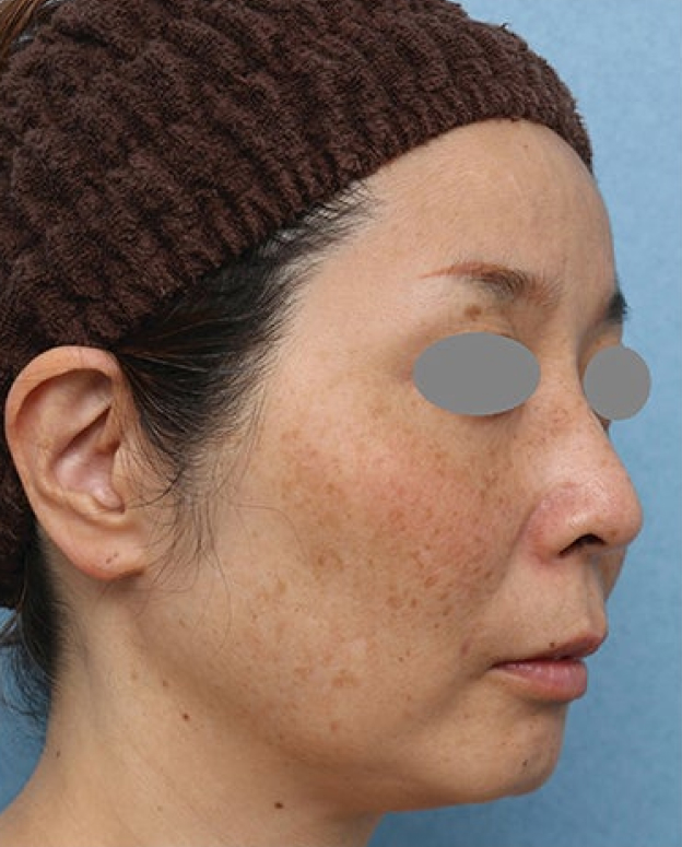 症例写真,ピコレーザーとトレチノインによるシミ治療の症例写真,Before,ba_picoway007_b02.jpg