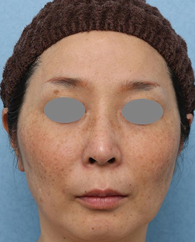 症例写真,ピコレーザーとトレチノインによるシミ治療の症例写真,Before,ba_picoway007_b03.jpg