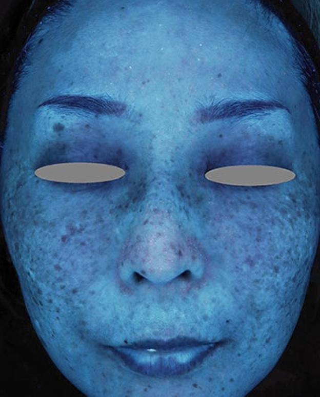 症例写真,ピコレーザーとトレチノインによるシミ治療の症例写真,Before,ba_picoway007_b04.jpg