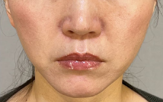ミニフェイスリフトと顎下の脂肪吸引を行った40代女性の症例写真,After（3ヶ月後）,ba_minilift032_a01.jpg