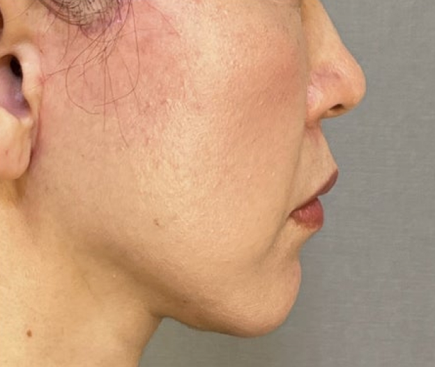 症例写真,ミニフェイスリフトと顎下の脂肪吸引を行った40代女性の症例写真,After（3ヶ月後）,ba_minilift032_b03.jpg