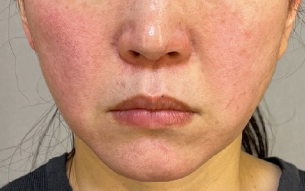 ミニフェイスリフトと顎下の脂肪吸引を行った40代女性の症例写真,Before,ba_minilift032_b01.jpg