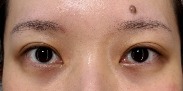 大きくて柔らかな癒し系の目を作る、垂れ目（パンダ目）形成施術の症例写真,After（3ヶ月後）,ba_panda028_a01.jpg