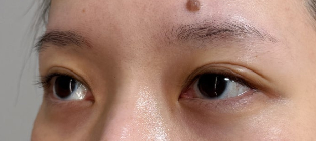 症例写真,大きくて柔らかな癒し系の目を作る、垂れ目（パンダ目）形成施術の症例写真,After（3ヶ月後）,ba_panda028_b02.jpg
