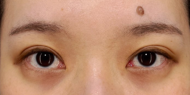 大きくて柔らかな癒し系の目を作る、垂れ目（パンダ目）形成施術の症例写真,Before,ba_panda028_b01.jpg