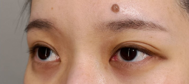 症例写真,大きくて柔らかな癒し系の目を作る、垂れ目（パンダ目）形成施術の症例写真,Before,ba_panda028_b02.jpg