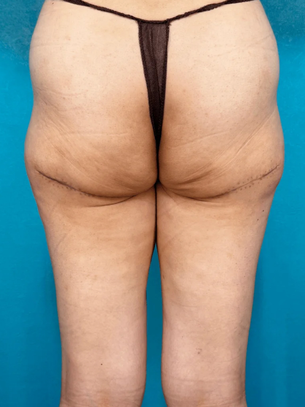 ヒップアップ手術（お尻のたるみ取り）,ダイエット後の皮膚のたるみをヒップリダクションで改善した30代女性の症例写真,After（3ヶ月後）,ba_hipup002_a01.jpg