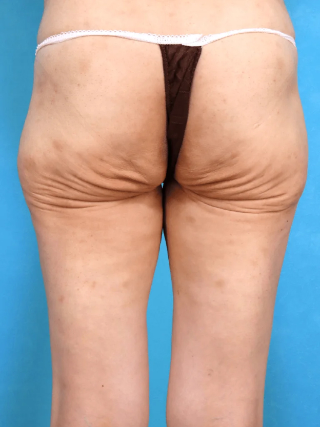 ヒップアップ手術（お尻のたるみ取り）,ダイエット後の皮膚のたるみをヒップリダクションで改善した30代女性の症例写真,Before,ba_hipup002_b01.jpg