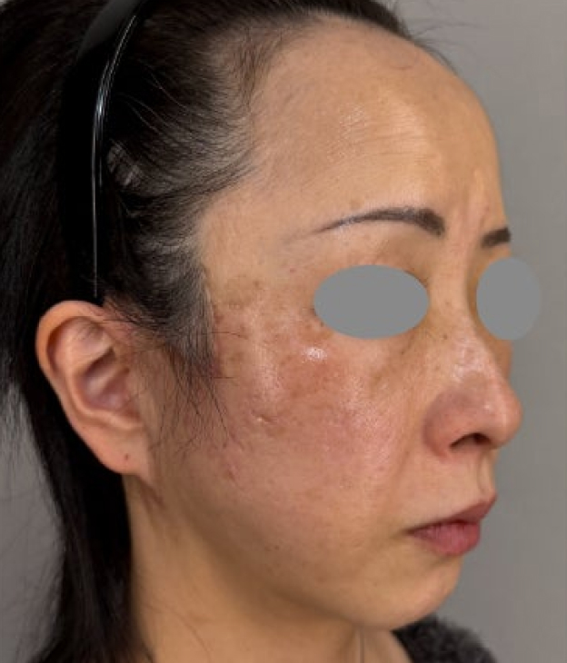 症例写真,ミディアムフェイスリフトとジョールファット除去を行った60代女性の症例写真,After（3ヶ月後）,ba_mediumlift031_b02.jpg
