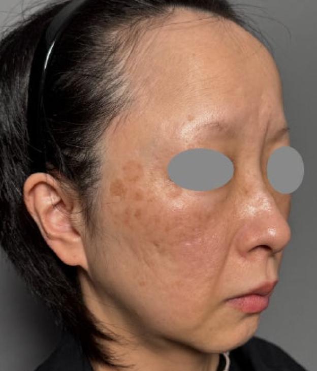 症例写真,ミディアムフェイスリフトとジョールファット除去を行った60代女性の症例写真,Before,ba_mediumlift031_b02.jpg
