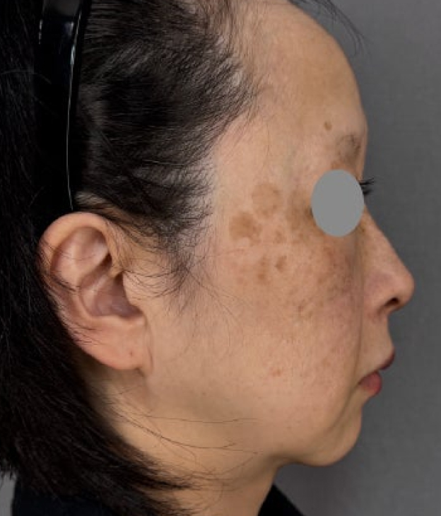 症例写真,ミディアムフェイスリフトとジョールファット除去を行った60代女性の症例写真,Before,ba_mediumlift031_b03.jpg