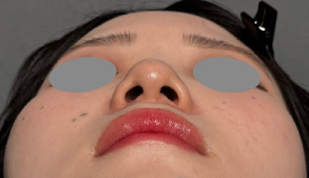 症例写真,小鼻の広がりに対して鼻翼縮小（小鼻縮小）の内側法を行った症例写真,After（1ヶ月後）,ba_biyoku064_b02.jpg