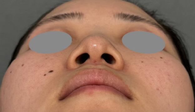 症例写真,小鼻の広がりに対して鼻翼縮小（小鼻縮小）の内側法を行った症例写真,Before,ba_biyoku064_b02.jpg