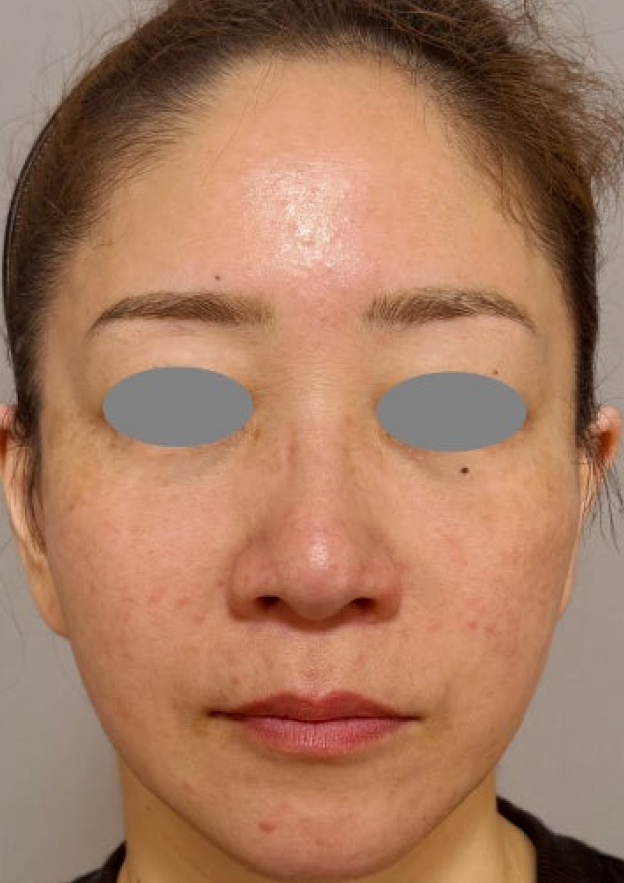 フルフェイスリフトで顔や首まわりの皺・たるみを改善した症例写真,After（3ヶ月後）,ba_facelift013_a01.jpg