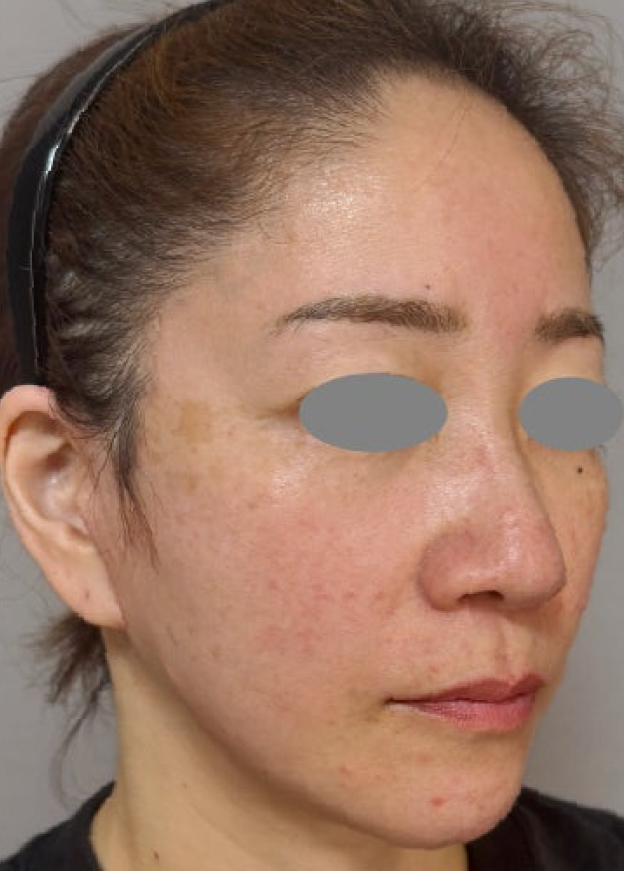 症例写真,フルフェイスリフトで顔や首まわりの皺・たるみを改善した症例写真,After（3ヶ月後）,ba_facelift013_b02.jpg