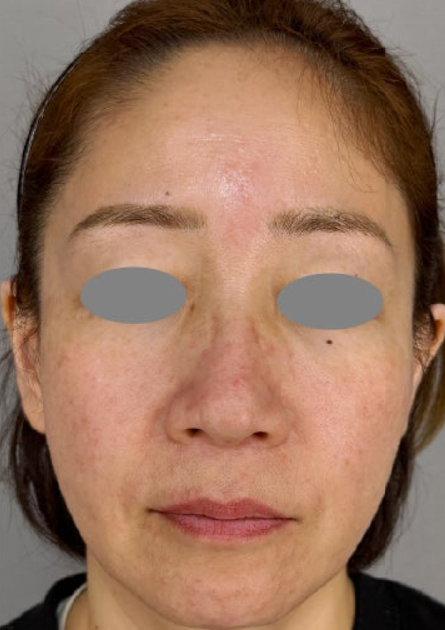 フルフェイスリフトで顔や首まわりの皺・たるみを改善した症例写真,Before,ba_facelift013_b01.jpg