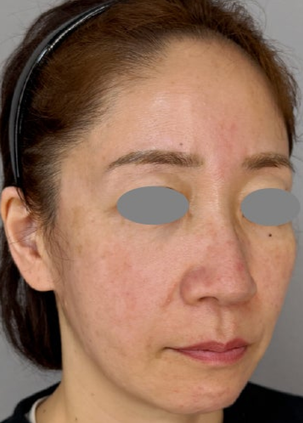 症例写真,フルフェイスリフトで顔や首まわりの皺・たるみを改善した症例写真,Before,ba_facelift013_b02.jpg