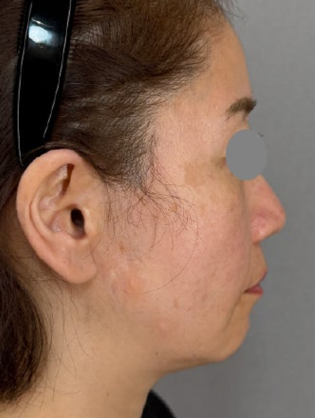 症例写真,フルフェイスリフトで顔や首まわりの皺・たるみを改善した症例写真,Before,ba_facelift013_b03.jpg