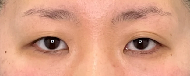 二重まぶた・全切開法と目頭切開を行った症例写真,Before,ba_sekkai124_b01.jpg