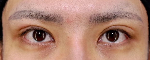 二重まぶた・全切開法,目頭切開,末広型二重の患者様に二重まぶた・全切開法と目頭切開を行って、目頭までラインが入るような二重にした症例写真,After（3ヶ月後）,ba_sekkai125_a01.jpg