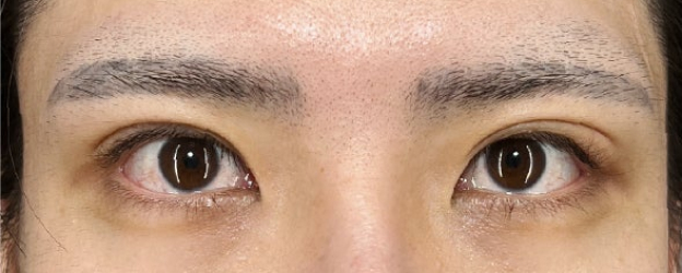 二重まぶた・全切開法,目頭切開,末広型二重の患者様に二重まぶた・全切開法と目頭切開を行って、目頭までラインが入るような二重にした症例写真,Before,ba_sekkai125_b01.jpg