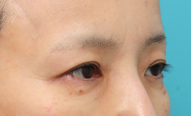 症例写真,上眼瞼リフト（眉下切開リフト）を行った50代女性の症例写真,After（6ヶ月後）,ba_jougankenlift019_b02.jpg