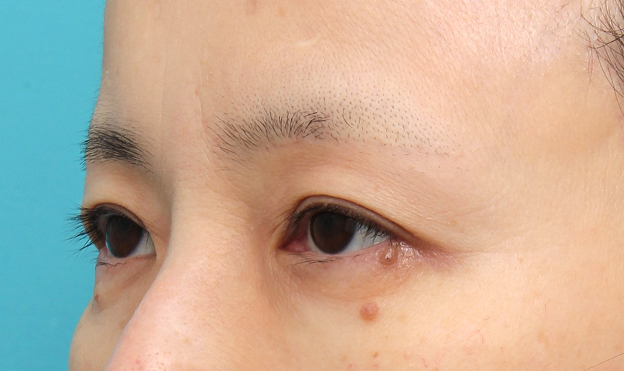 症例写真,上眼瞼リフト（眉下切開リフト）を行った50代女性の症例写真,After（6ヶ月後）,ba_jougankenlift019_b03.jpg