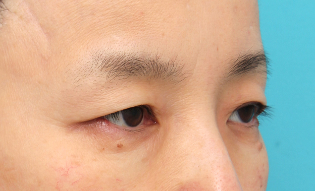症例写真,上眼瞼リフト（眉下切開リフト）を行った50代女性の症例写真,Before,ba_jougankenlift019_b02.jpg