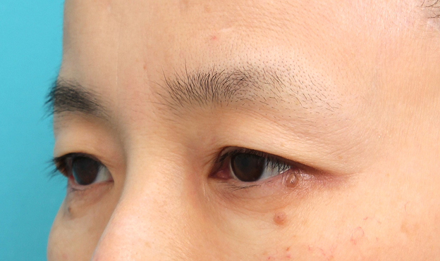 症例写真,上眼瞼リフト（眉下切開リフト）を行った50代女性の症例写真,Before,ba_jougankenlift019_b03.jpg