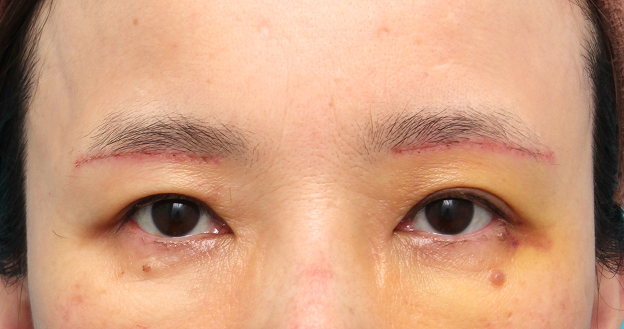 症例写真,上眼瞼リフト（眉下切開リフト）を行った50代女性の症例写真,1週間後,mainpic_jougankenlift018c.jpg