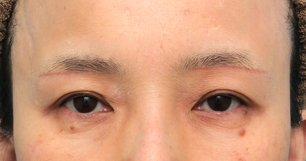 症例写真,上眼瞼リフト（眉下切開リフト）を行った50代女性の症例写真,3週間後,mainpic_jougankenlift018d.jpg
