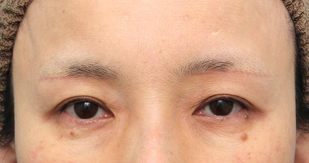 症例写真,上眼瞼リフト（眉下切開リフト）を行った50代女性の症例写真,2ヶ月後,mainpic_jougankenlift018e.jpg