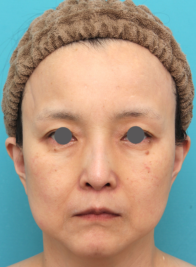 鼻の下を短く（上口唇短縮手術、上口唇リフト、リップリフト、人中短縮術）,人中短縮手術を行った50代女性の症例写真,After（6ヶ月後）,ba_hanashita016_a01.jpg