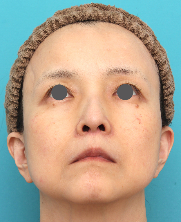 症例写真,人中短縮手術を行った50代女性の症例写真,After（6ヶ月後）,ba_hanashita016_b02.jpg