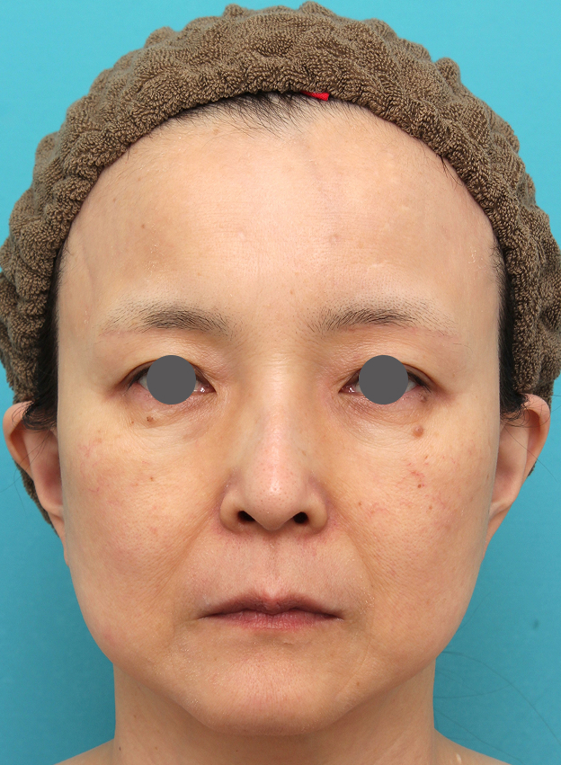 鼻の下を短く（上口唇短縮手術、上口唇リフト、リップリフト、人中短縮術）,人中短縮手術を行った50代女性の症例写真,Before,ba_hanashita016_b01.jpg