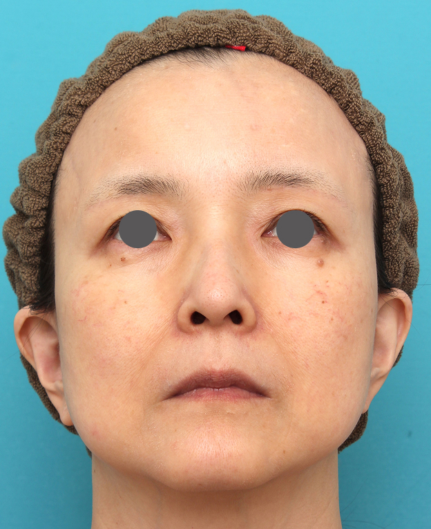 症例写真,人中短縮手術を行った50代女性の症例写真,Before,ba_hanashita016_b02.jpg