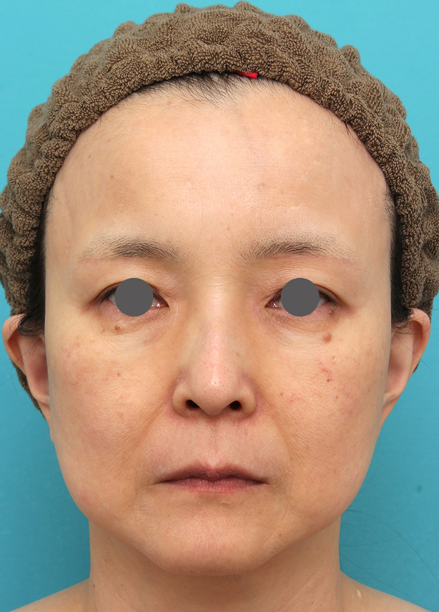 症例写真,人中短縮手術を行った50代女性の症例写真,手術前,mainpic_hanashita016a.jpg