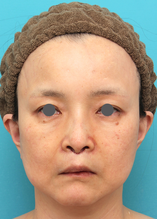 症例写真,人中短縮手術を行った50代女性の症例写真,手術直後,mainpic_hanashita016b.jpg