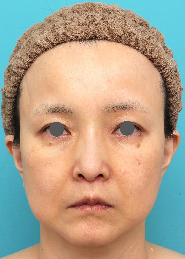 症例写真,人中短縮手術を行った50代女性の症例写真,1週間後,mainpic_hanashita016c.jpg