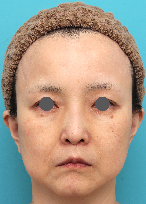 症例写真,人中短縮手術を行った50代女性の症例写真,3週間後,mainpic_hanashita016d.jpg