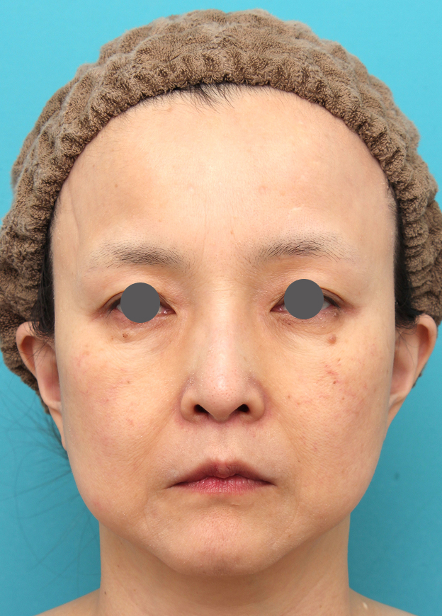 症例写真,人中短縮手術を行った50代女性の症例写真,2ヶ月後,mainpic_hanashita016e.jpg