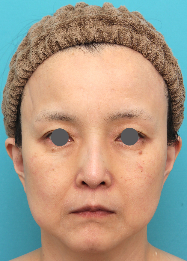 症例写真,人中短縮手術を行った50代女性の症例写真,6ヶ月後,mainpic_hanashita016f.jpg