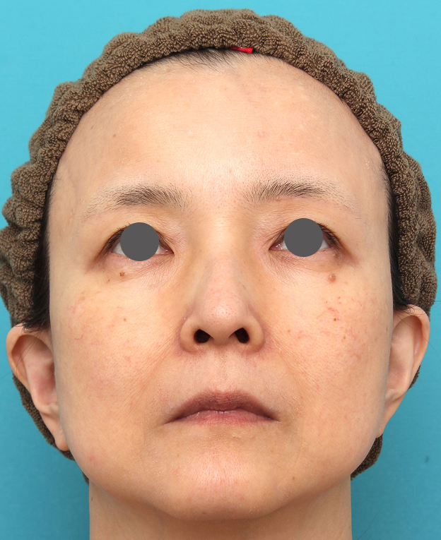 症例写真,人中短縮手術を行った50代女性の症例写真,手術前,mainpic_hanashita016g.jpg