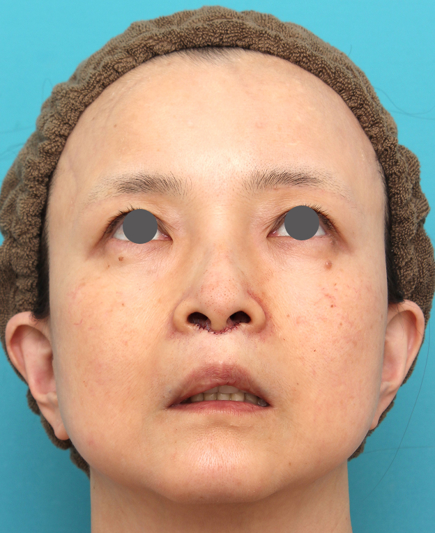 症例写真,人中短縮手術を行った50代女性の症例写真,手術直後,mainpic_hanashita016h.jpg