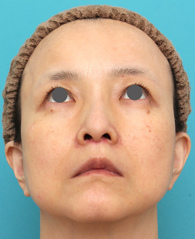 症例写真,人中短縮手術を行った50代女性の症例写真,1週間後,mainpic_hanashita016i.jpg