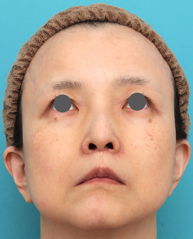症例写真,人中短縮手術を行った50代女性の症例写真,3週間後,mainpic_hanashita016j.jpg