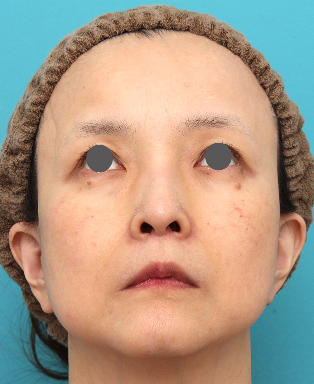 症例写真,人中短縮手術を行った50代女性の症例写真,2ヶ月後,mainpic_hanashita016k.jpg