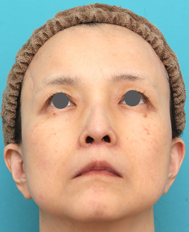 症例写真,人中短縮手術を行った50代女性の症例写真,6ヶ月後,mainpic_hanashita016l.jpg