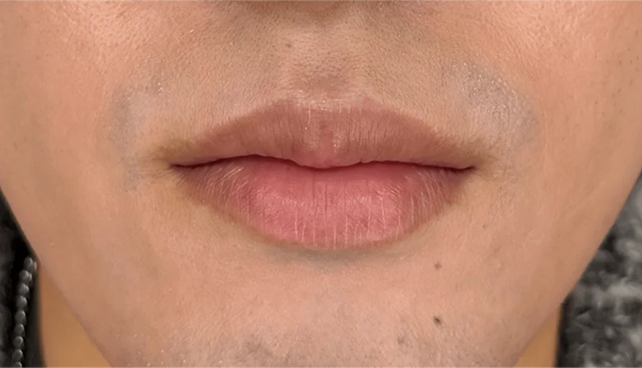上唇を薄くして形を整えた症例写真,After（3ヶ月後）,ba_usuku031_a01.jpg